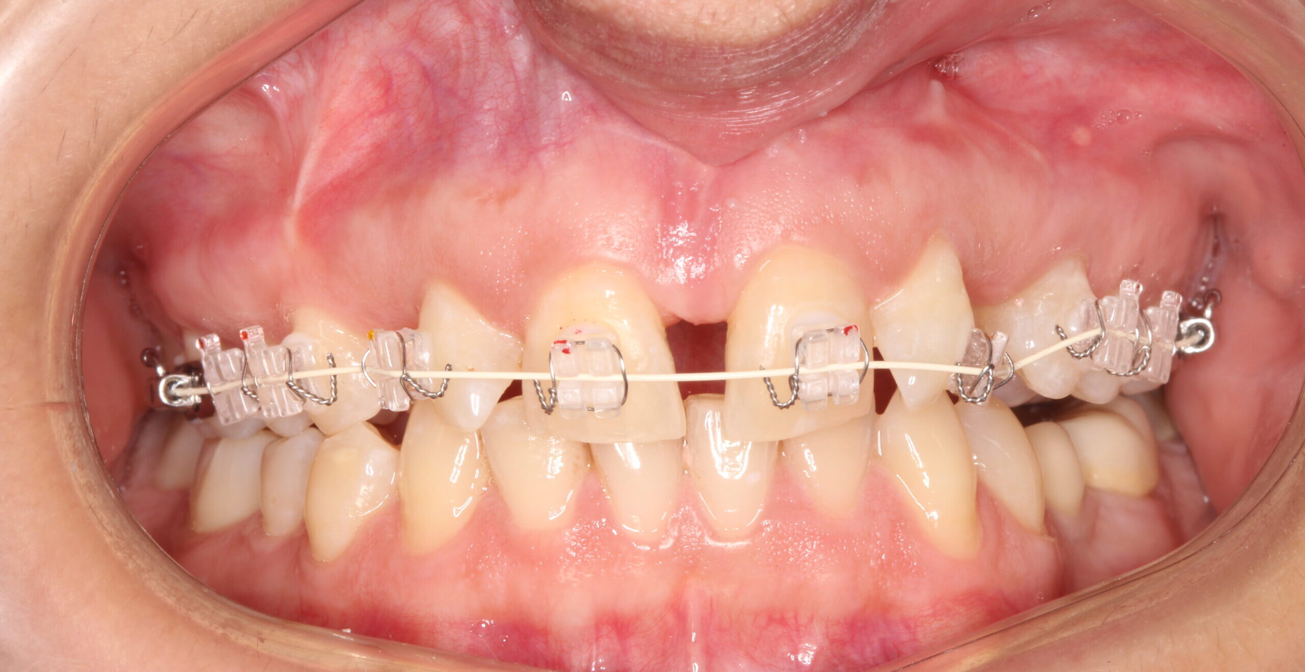 Metal and Ceramic Braces & Invisible Aligners – Toothbuddies